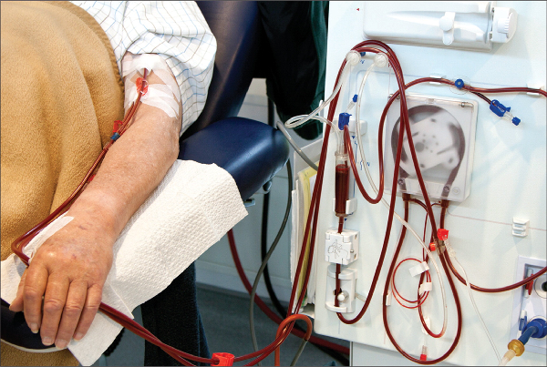 Renal Replacement Therapy
