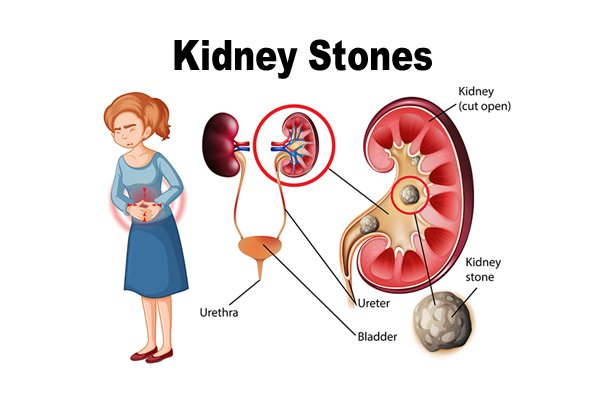 Kidney Stones