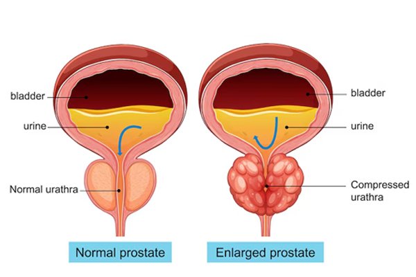 Glomerulonephritis